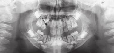 Predoperativna klinička slika vidi se asimetrija i oteklina na desnoj strani gornje čeljusti Figure 1