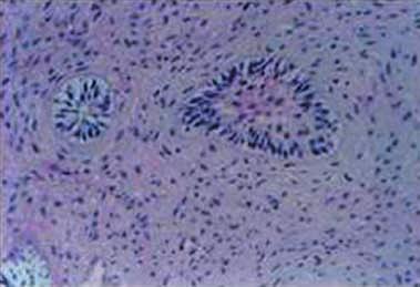 Histopatološka nakupina ameloblastima sličnih stanica zaokružena bazalnom membranom u vretenastoj