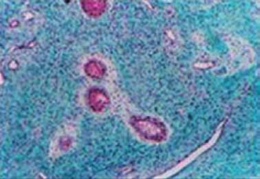 Figure 4 Histopathologic image groups of ameloblast like cells surrounded by a basal membrane in a