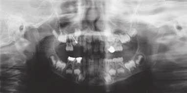 Figure 8 A postoperative panoramic radiograph showing no evidence of recurrence 2 years after surgery Slika 9.