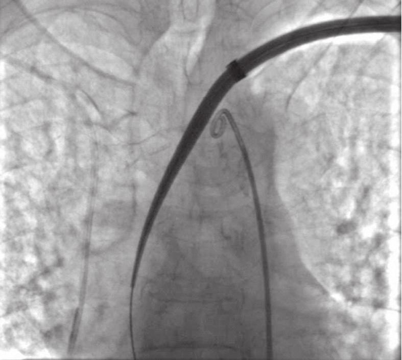 16 Figure 6. The 18 F introducer is inserted from the distal part of the left axillary artery. The tip of the introducer with radipaque marker is advanced at least 10 mm in the aortic arch. Figure 7.