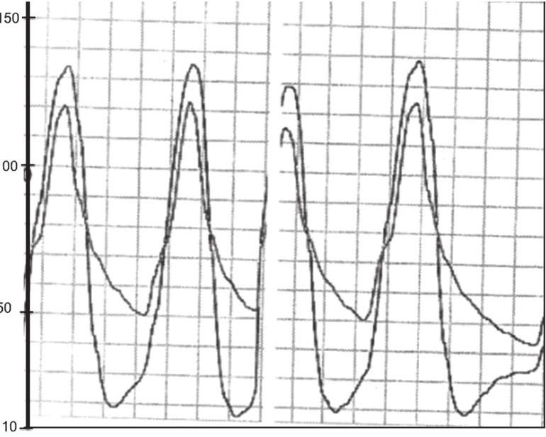17 Figure 8. Hemodinamic assesssment of severe aortic regurgitation by simultaneous measurement of aortic and left ventricular pressures. Figure 9.