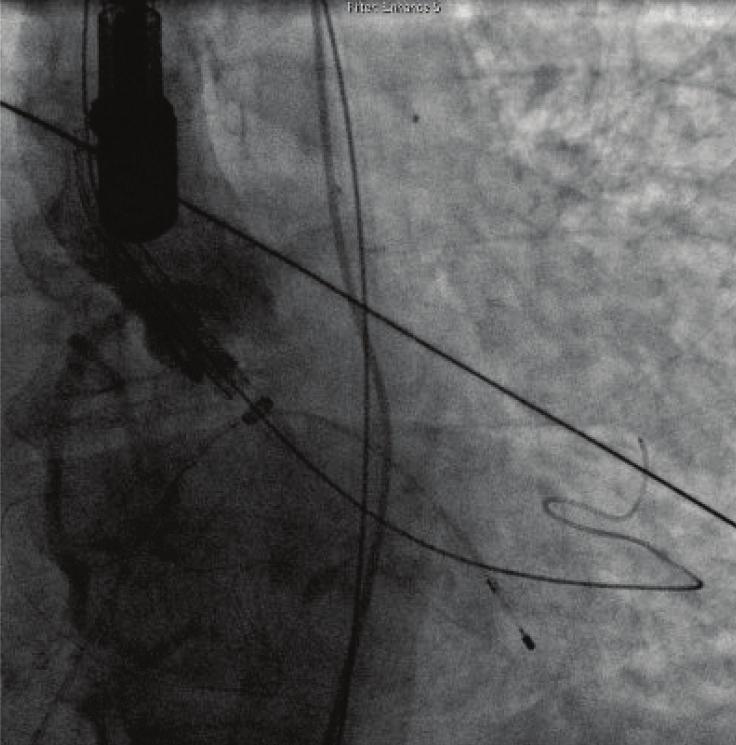 A severe pulmonary hypertension of 85 mmhg was also found. Cardiac catheterization showed patent coronary artery bypasses with no new significant disease on other coronary arteries.