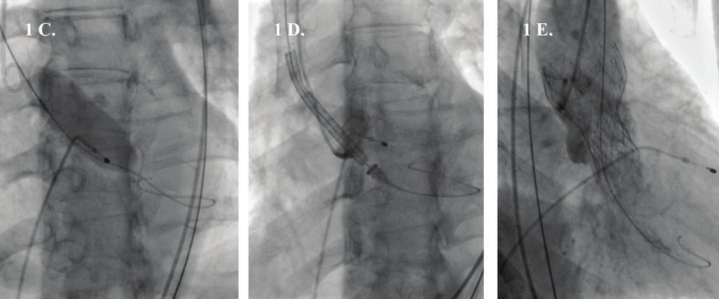 31 1a. Gradijent nad aortnom valvulom pre intervencije 1c. Valvuloplastika aortne valvule 1d. Pozicioniranje aortne valvule 1e. Paravalvularna aortna regurgitacija na aortografiji 1f.