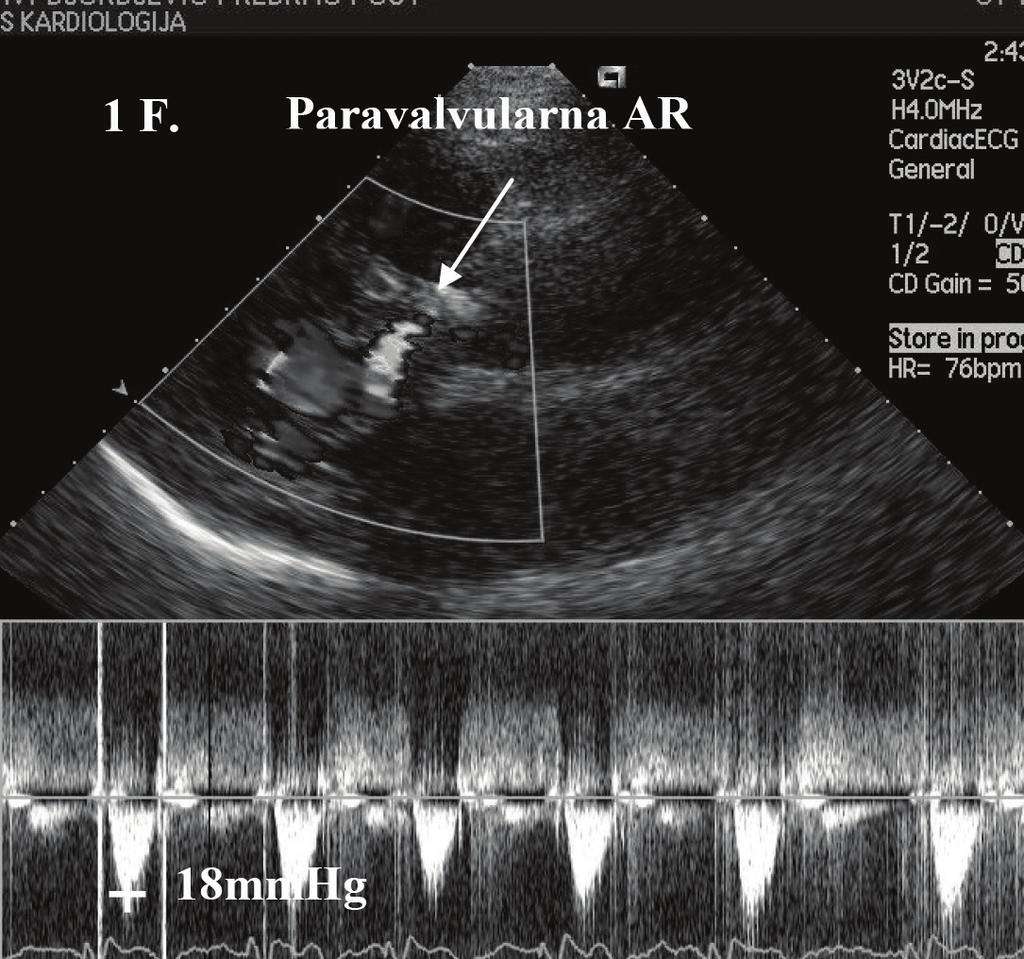 Takođe, potvrđeno je postojanje izražene kalcifikovane bivelarne aortne valvule (Figura 1b), što je tehnički predstavljalo teži slučaj za pozicioniranje i implantaciju valvule.