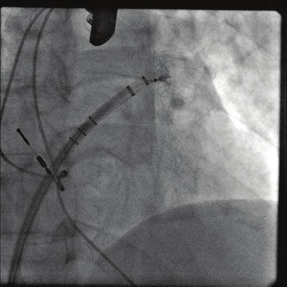 sheat. Heparin is then given to keep an ACT above 250 sec. Then, the Watchman Access Sheath and Dilator are advanced over a guidewire into the left atrium.