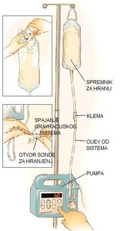 Slika 2.3.1.2. Prikaz seta za hranjenje pomoću enteralne pumpe Izvor: http://uintageneralsurgery.