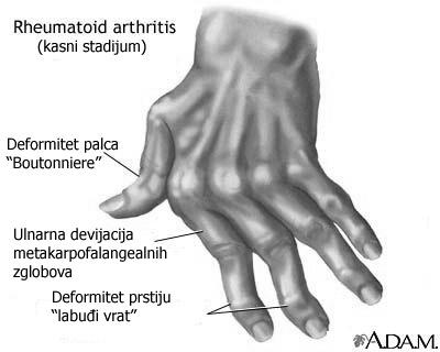Zapaljenski Reumatoidni artritis progresivno, sistemsko i hronično obolenje. patoanatomski upala vezivnog tkiva kolagenoza sistemska bolest. Početak između 20-e i 45-e god.