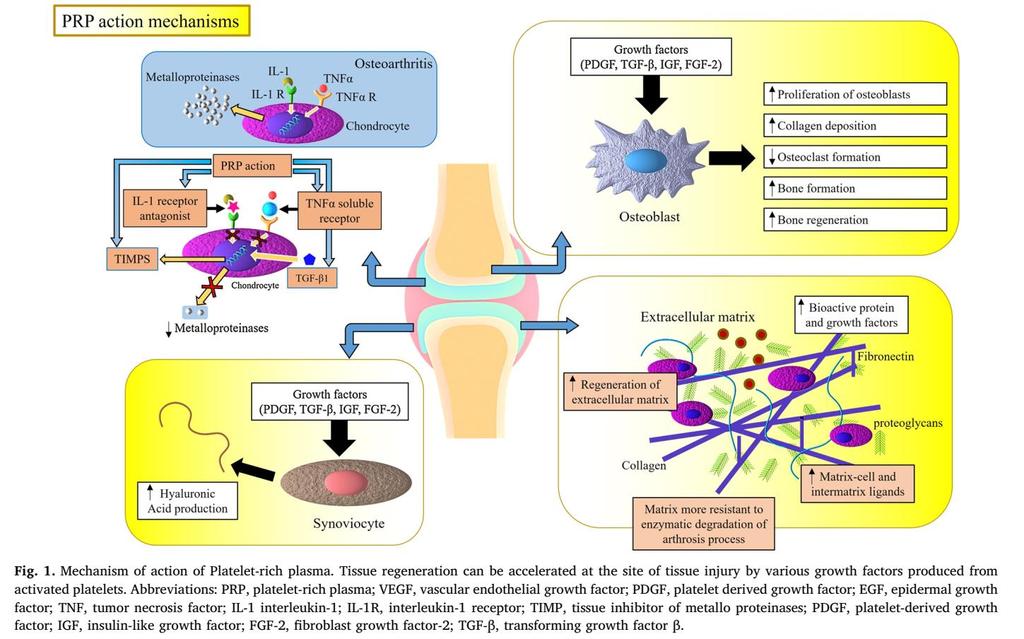 Sellam J, Richette P, Chevalier X. Does platelet-rich plasma have a role in the treatment of osteoarthritis?. Joint Bone Spine. 2016 Jan 1;83(1):31-6.