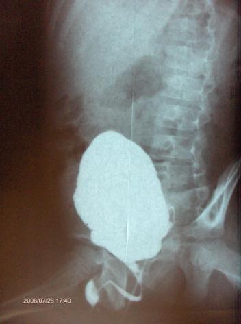 Слика Бр 12: Сцинтиграфија (код истог пацијента) на којој се види афункција левог бубрега. Касније је урађена лева нефректомија, а дистални уретер је искоришћен за континентну везикостому. 5.
