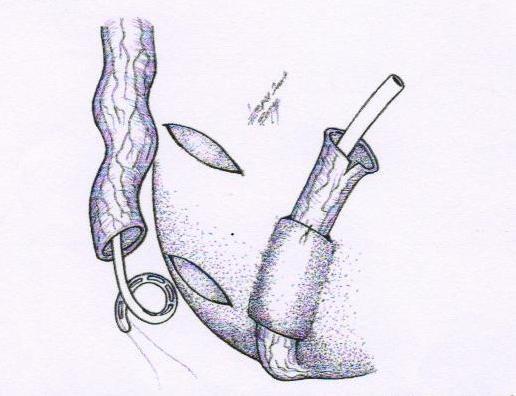 Слика бр 9:Антирефлукс процедура катетризабилне стоме дисталним уретером С обзиром на то да је главна