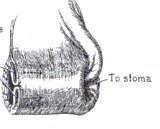 Употреба Шнајдерове технике креирањем бешичног тубуса од предњег зида мокраћне бешике као предњи флап од пуног зида, отприлике око 9 цм у дужини и 3-5 цм у ширини(слика12а, 12Б).