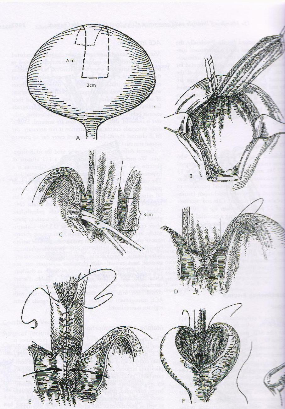 Детаљи ове технике су приказани сликом (слика бр 12).