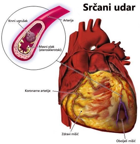 srčani udar u starijih osoba s hipertenzijom
