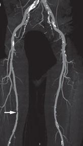 CTA omogućuje nam i pregled perifernih arterijskih stentova zbog toga što ne dolazi do ispada signala kao što je to kod snimanja MRA.