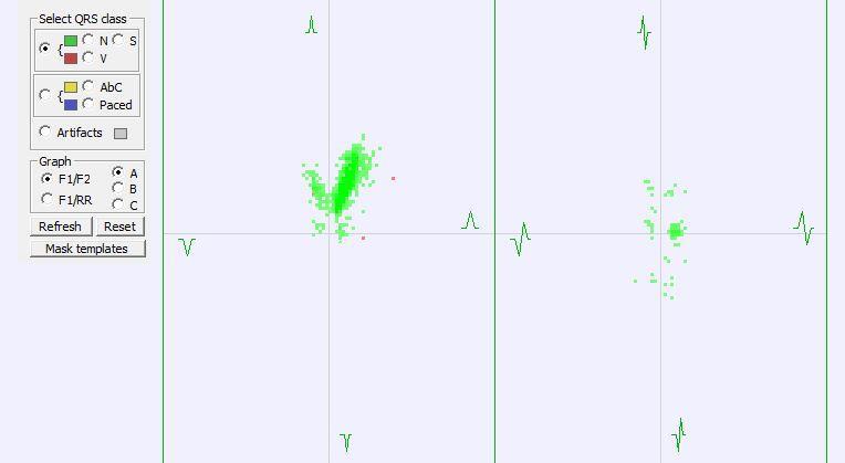 snimka i grafički prikazao krivu srčane frekvencije, u nastavku automatske analize najpre je na grafikonu prikazao vrstu QRS kompleksa koja je opredeljena kao čitka (zelene boje)