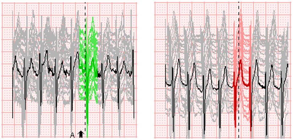 provereno da li je softver eventualno načinio grešku prilikom analize EKG signala i samim tim čitak signal klasifikovao kao nečitak i obrnutom.