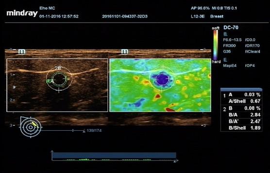 Slika 46: Ultrazvučna slika sa lokacijom i markiranjem manje ( 9 mm) patološke lezije koja je neoštro konturisana, vertikalne orijentacije.