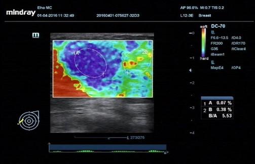 Nekada ultrazvučne karakteristike benigne lezije oštro konturisane, hipoehogene i homogene, horizontalne orijentacije metodom elastografije dobijemo u mapi plavu boju visokog indeksa otprornosti