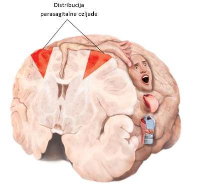 ) je bilateralna, obično simetrična, nekroza korteksa i subkortikalne bijele tvari, iako može biti upečatljivija u jednoj od hemisfera.