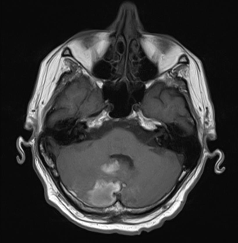 Magnetna rezonancija se danas najčešće koristi kao nastavak dijagnostičkog algoritma (slika 3), nakon incijalno učinjene kompjuterizirane tomografije kojom se identificira hematom, a može se