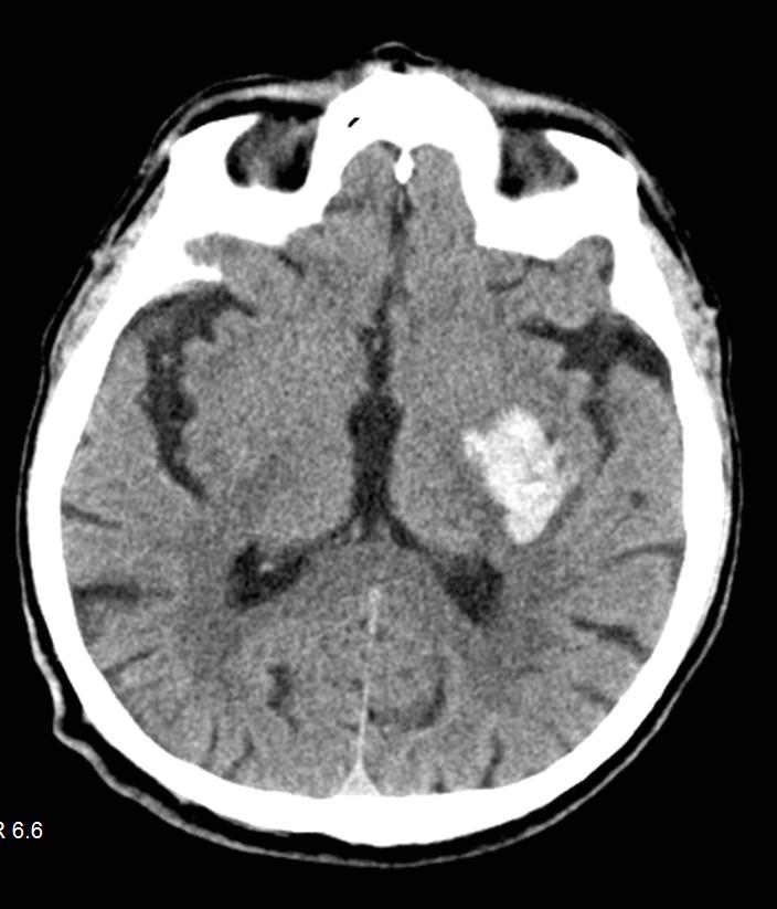 8.2 CT karakterisitike i klasifikacija ICH Na temelju neuroslikavanja kompjuteriziranom tomografijom, supratentorijalni intracerebralni hematomi se mogu topografski u odnosu na površinu mozga