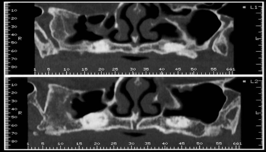 Slika 2. Dentalni CT nakon sinus liftinga Figure 2. Dental CT after sinus lift procedure U prvoj fazi učinjen je obostrani sinus lifting u lokalnoj anesteziji.