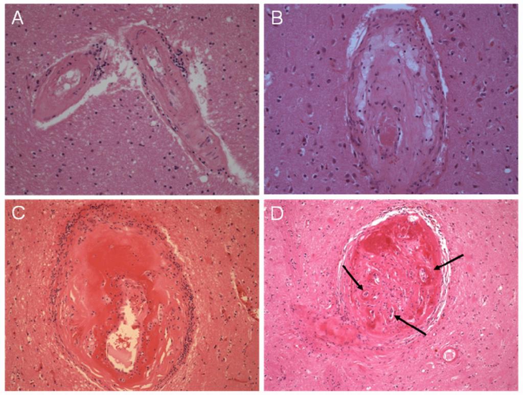 Slika 1. Tipične patološke promjene u arteriolama zahvaćenim moždanom mikroangiopatijom.