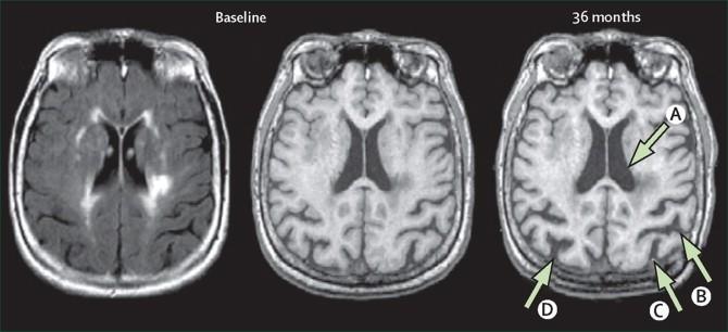 6.7. Atrofija mozga Atrofija mozga pojavljuje se u brojnim poremećajima. Može biti žarišna ili generalizirana, simetrična ili asimetrična, a može biti i tkivno selektivna (pr.