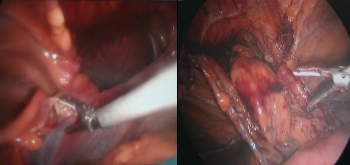 11.3 Transtorakalni pristup. Gastroplikacija po Belseyju Mark IV je antirefluksna procedura koja se izvodi lijevom torakotomijom.