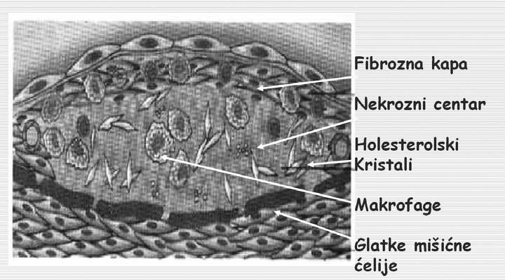 Aterosklerotski proces dovodi do formiranja abnormalnih nakupina lipida u zidu velikih arterijskih krvnih sudova, kakve su epikardne koronarne arterije, do infiltracije vaskularnog zida leukocitima