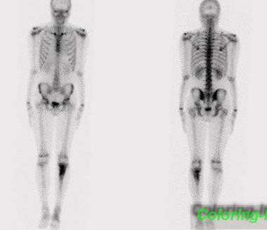 Scintigrafija Scintigrafija kosti je dijagnostička pretraga kojom se otkrivaju promjene na kostima i do 6 mjeseci prije neko na RTG snimkama.