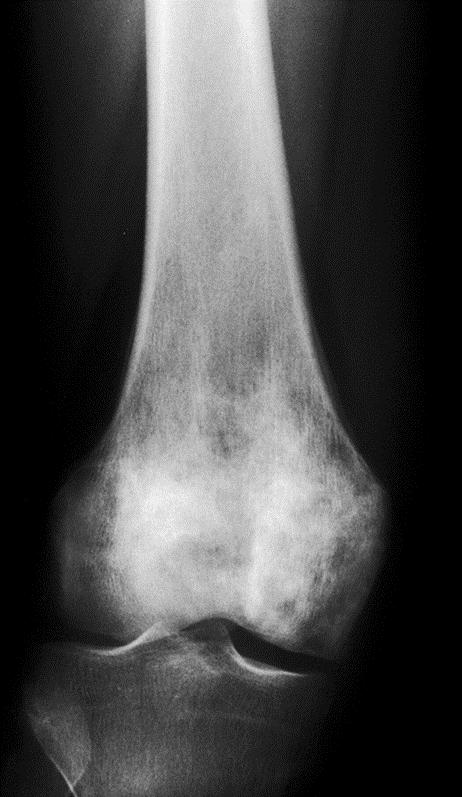 Slika 2. Rendgenska snimka miješane litičko-sklerotične lezije distalnog dijela bedrene kosti. Prema: Krishnan i suradnici (2003), 20 str. 1378. Preuzeto 08.06.2020. s: https://pubs.rsna.