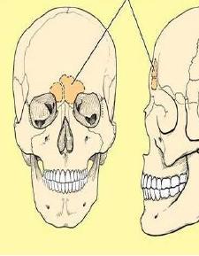 Slika 2. Sinus frontalis (Izvor: Slideshare / Anatomy of nose and paranasal sinus) 2.3. Sinus maxillaris, maksilarni sinus Sinus maxillaris (Slika 3.