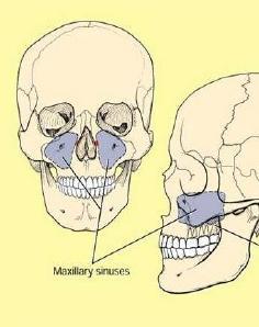 može zahvatiti i sinus. Pri vađenju zuba može puknuti korijen. Ako se pravilno ne izvadi, otkinuti dio može prodrijeti u maksilarni sinus i tako stvoriti komunikaciju između usne i sinusne šupljine.