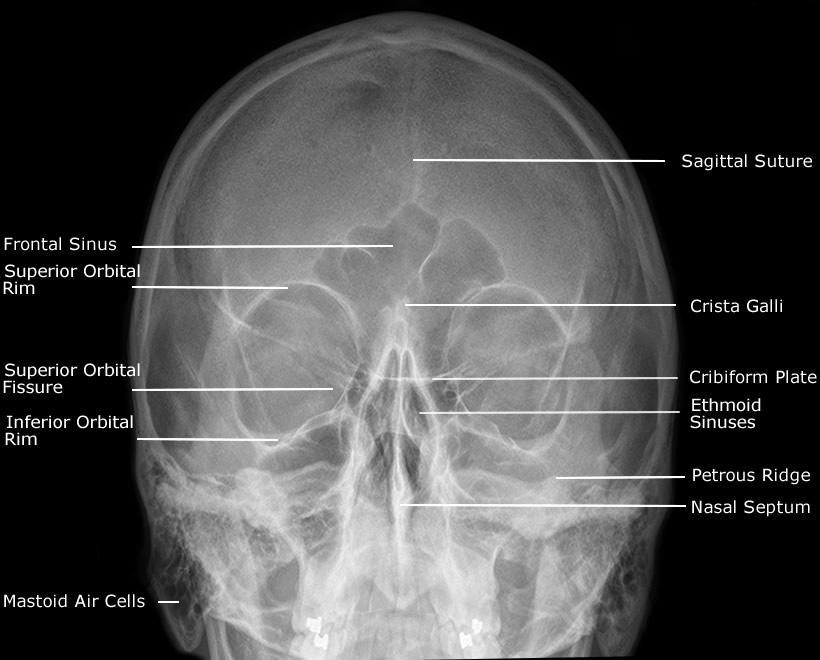 4. RADIOLOŠKA DIJAGNOSTIKA PARANAZALNIH ŠUPLJINA Paranazalne šupljine su prostori unutar kostiju lubanje i lica ispunjeni zrakom.
