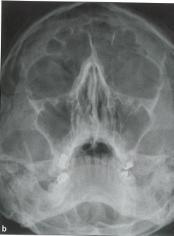 Radiogram baze lubanje submentovertikalna projekcija Pacijent sjedi leđima okrenut vertikalnom stativu, medijanu ravninu glave treba centrirati