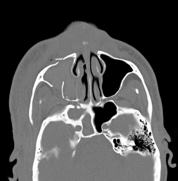 Slika 17. CT, koštani prozor multifragmentarna fraktura desnog maksilarnog sinusa (Izvor: KBC Split) 5.3.