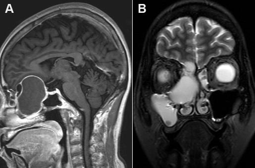 5.4.1. Tumori i lezije slične tumorima 5.4.1.1. Encefalokele Encefalokele, poznate i kao cranium bifidum, defekti su neuralne cijevi karaterizirani vrećastim protruzijama mozga.