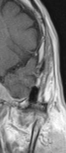 MR, koronarni presjek, T1 mjereno vrijeme s kontrastom, perineuralno širenje tumora (Izvor: KBC Split)