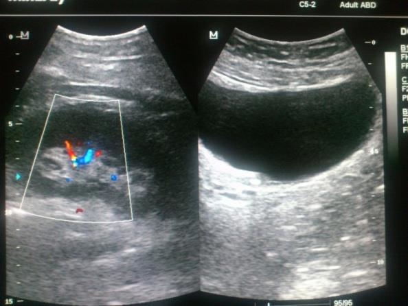 prikaz bubrega uz upotrebu kolor doplera-cd (desno) i ultrazvučni poprečni presek bešike sa prikazom mikrokalkulusa u