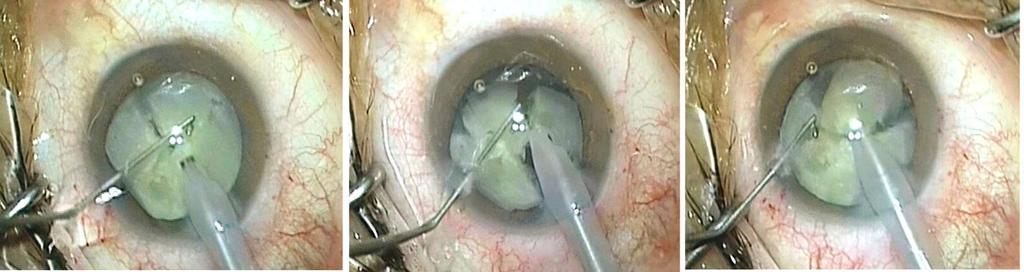 1. UVOD nakon ekstrakapsularne ekstrakcije leće.