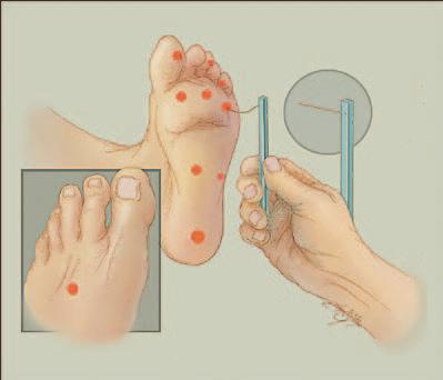ŠKOLA ZA OBOLJELE OD ŠEĆERNE BOLESTI Posljedice: Pacijent ne primjećuje povrede oboljelih dijelova tijela, najčešće stopala. Oštećenja nerava mogu se manifestovati i na drugi način, kao npr.