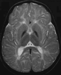 Manjom strelicom je označen hipointenzitet, a većom hiperintenzitet u globus palidusu (znak tigrovog oka ). Prema: Singh et al. 2012 Slika 3.3. MR prikaz mozga.