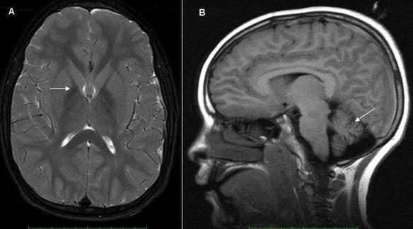 malog mozga (Slika 3.4.). Vidni evocirani potencijali (VEP) pokazuju kašnjenje sa smanjenim amplitudama, a elektromiogramom (EMG) se može dokazati denervacija.