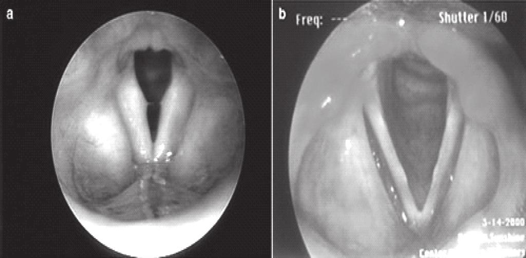Eritem/hiperemija grkljana Image 3 Laryngeal hyperemia/erythema lafsky kvantificirao u tzv.