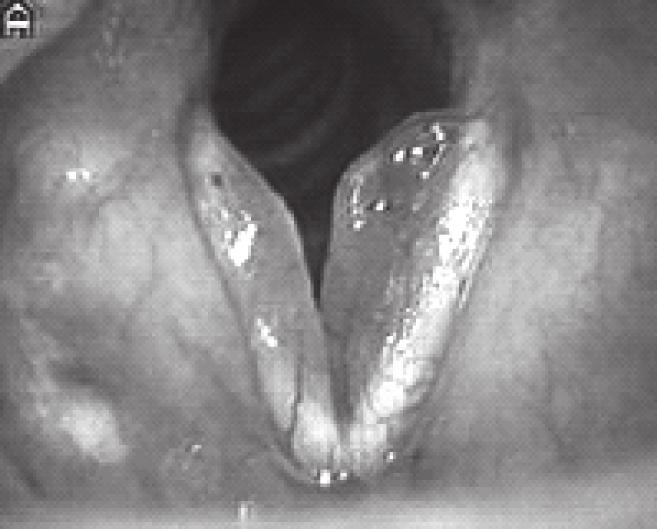 SLIKA 4. Edem glasnica IMAGE 4 Vocal cord edema Slika 5. Difuzni laringealni edem Image 5 Diffuse laryngeal edema SLIKA 6.