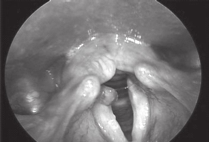 Slika 7. Granulomi/granulacije grkljana IMAGE 7 Laryngeal granulomas/granulations Slika 8.