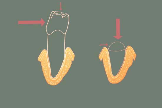 preostalih zuba, loš raspored, nepovoljan odnos kruna-koren, odnosno, redukovana alveolarna potpora, po etni stepen labavljenja zuba, zubi jako skra eni abrazijom, pojedina ni devitalizovni zubi ili