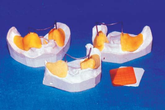 20 Stom Glas S, vol. 53, 2006. U trenutku predaje proteze pripremljeni su specijalni drža i Rtg filma za svakog pacijenta i svaki zub ponaosob i na injen je retroalveolarni snimak zuba.
